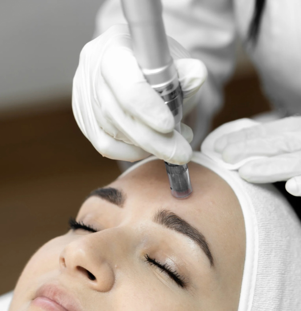 Microneedling