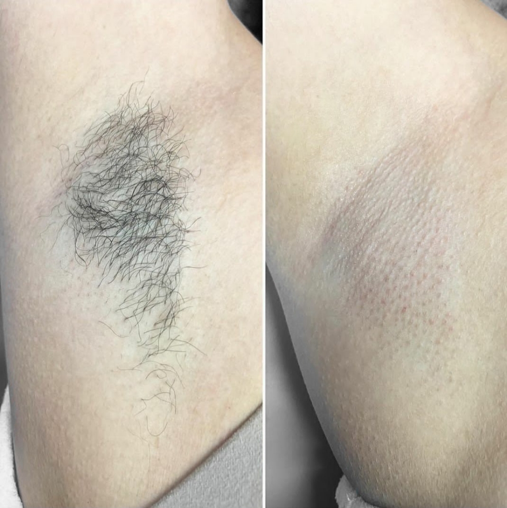 Underarms Sugaring