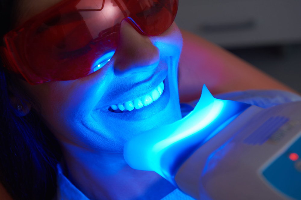60 Minute Teeth Whitening