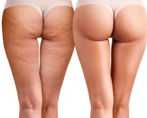 Cellulite Treatment