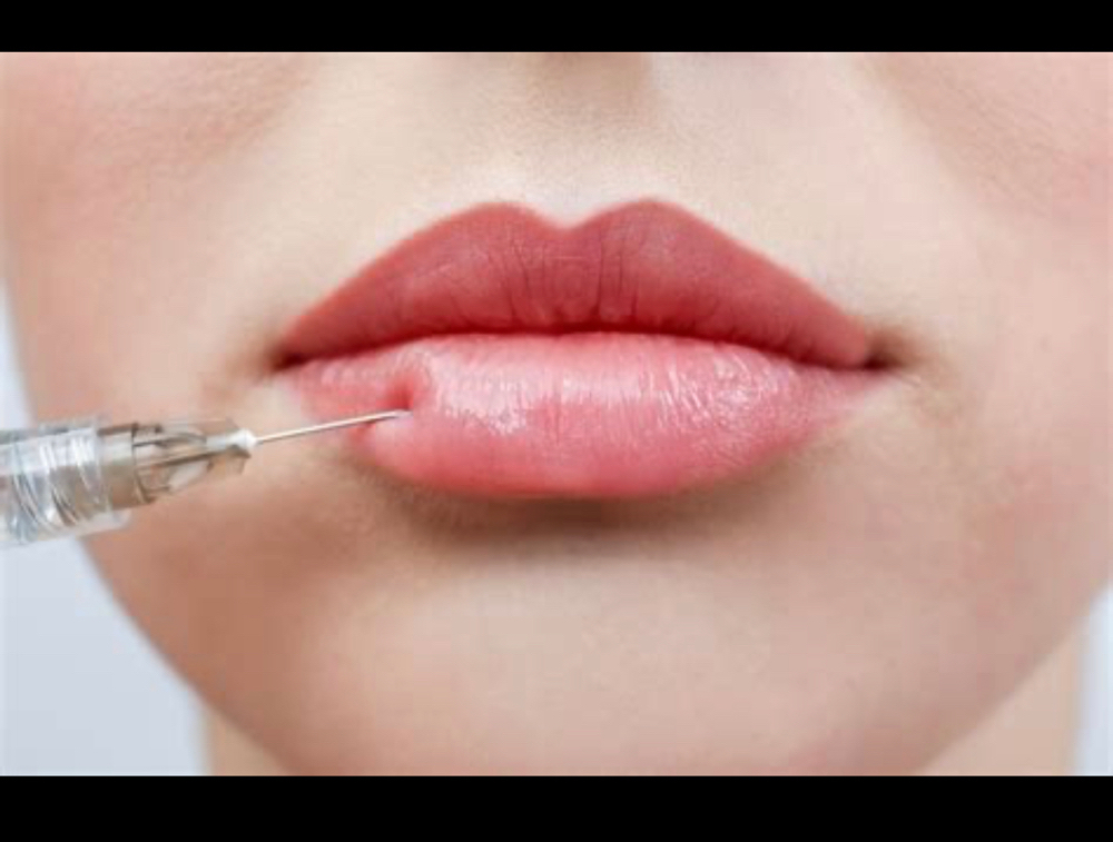 Lip Filler