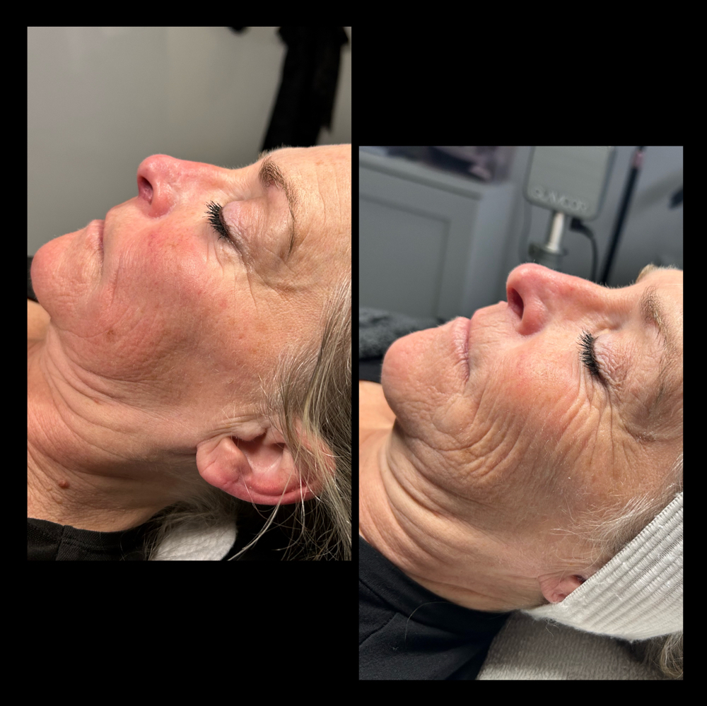 Microcurrent Skin Tightening