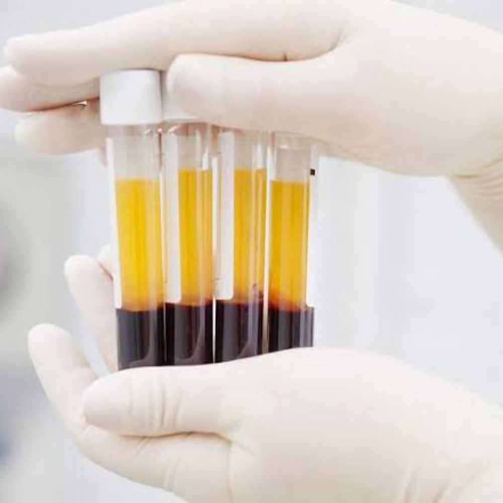 Platelet-rich plasma Treatment at Lash Co. in Spring Hill, FL