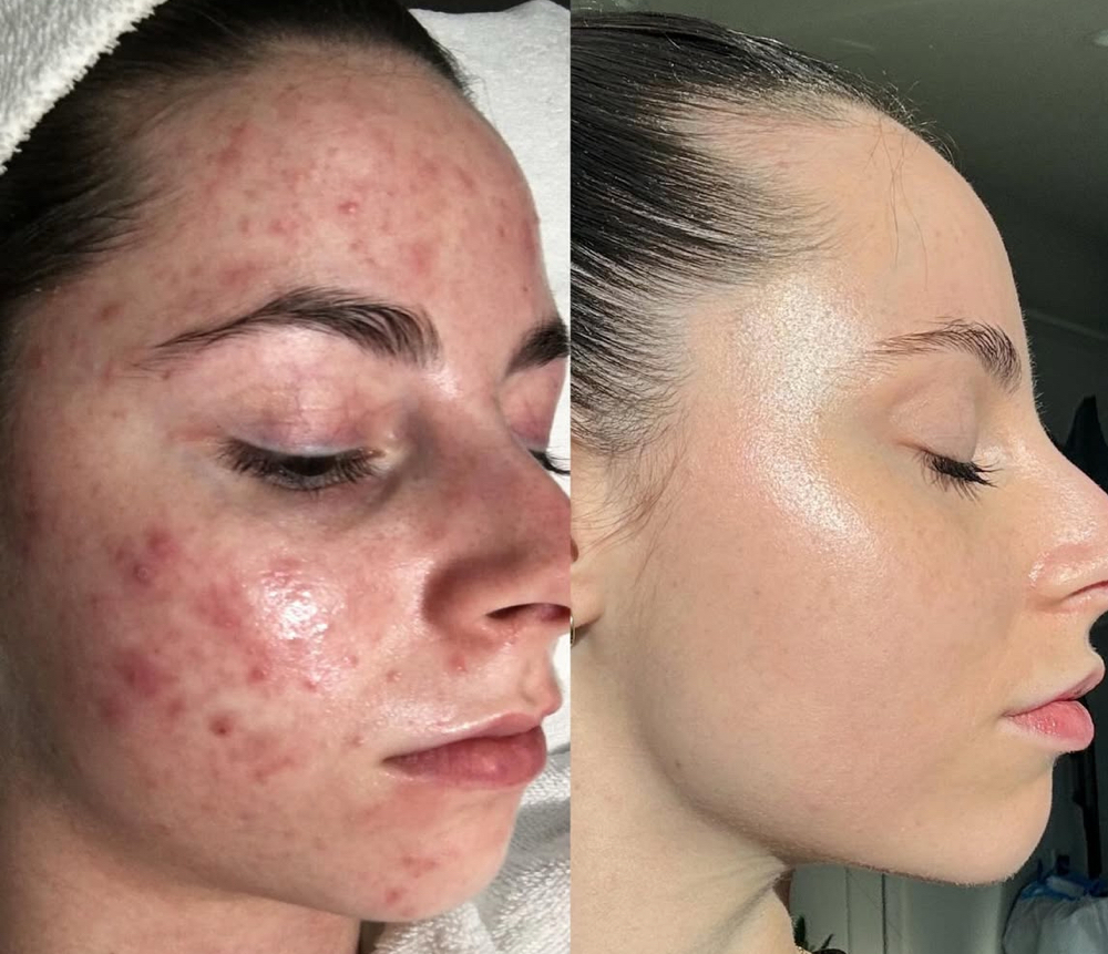 Mixi Method For Acne