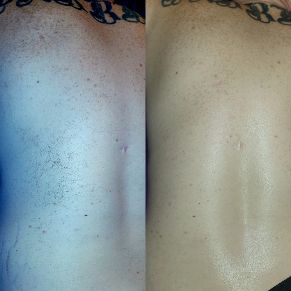 Back Facial