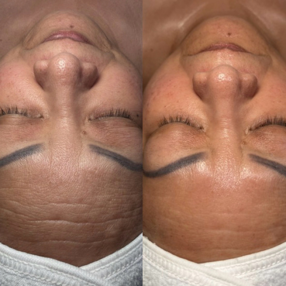 SWiCH Dermal Rejuvenation System at Elevate Aesthetics in Sandy, UT