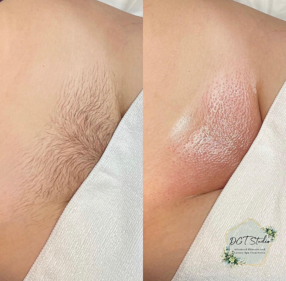 5 Week Or Initial Brazilian Wax