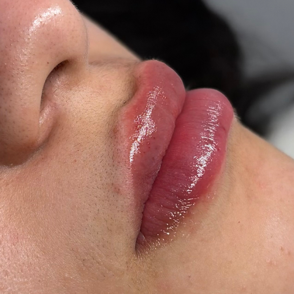 0.7ml Filler at Punchy Pouts & Esthetics in Amarillo, TX