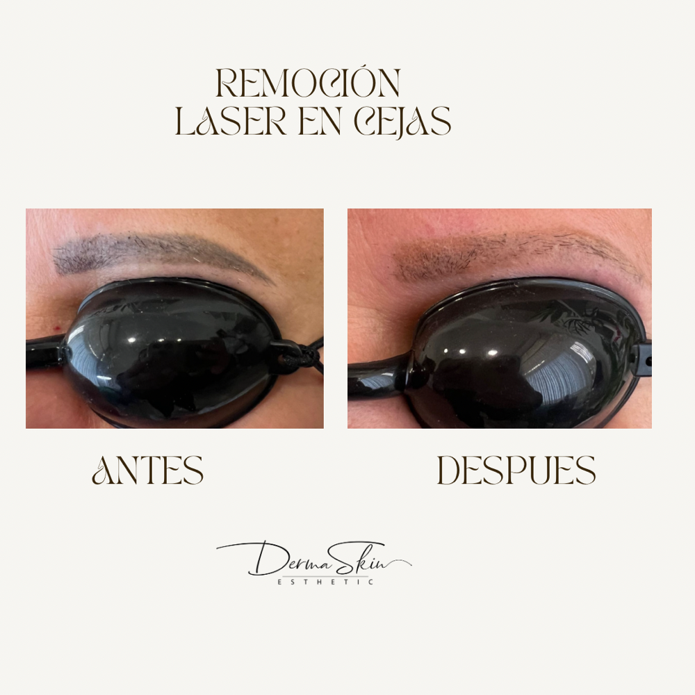 ☀️ Flash Sale Remocion Cejas Laser