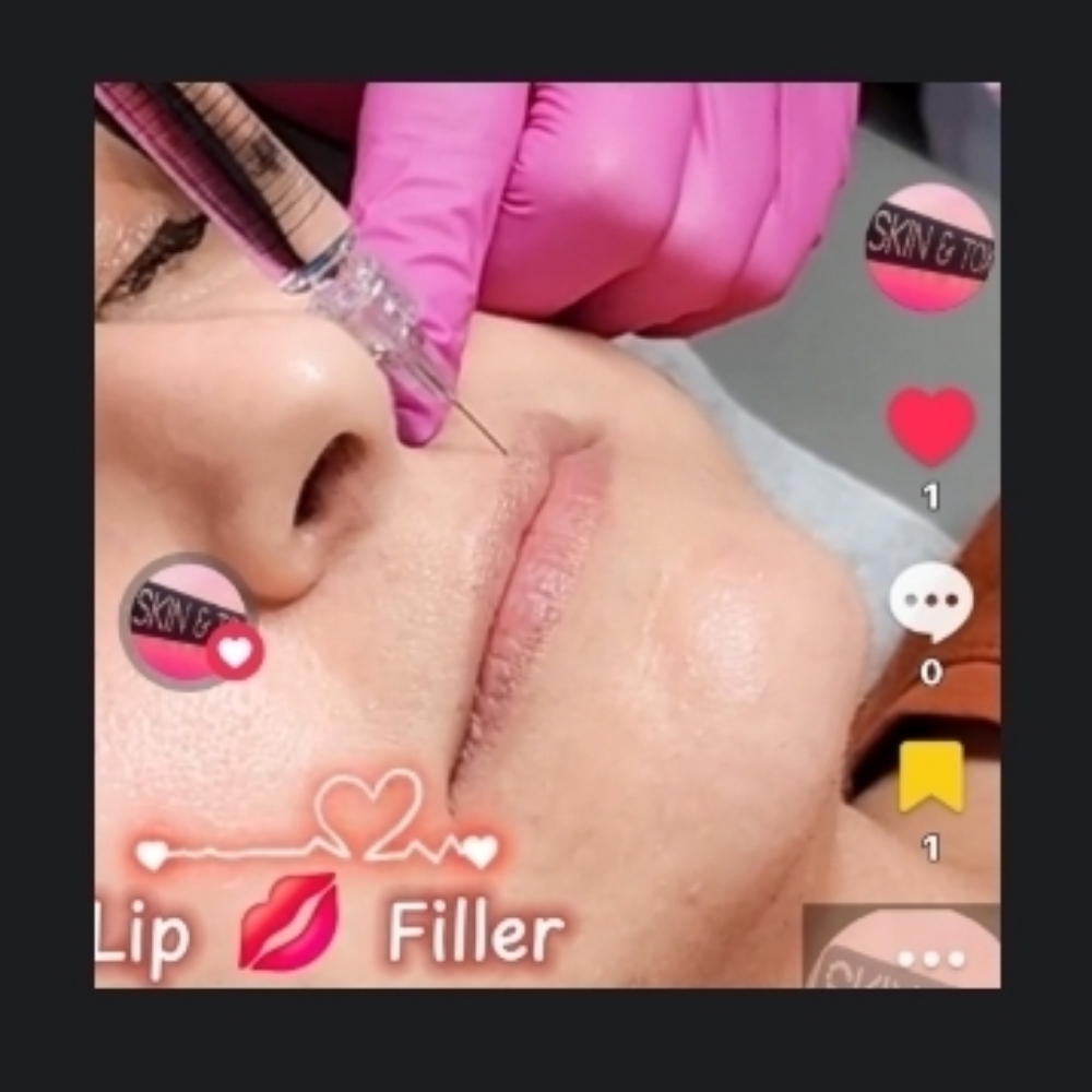 Derma Filler for face and lips at Skin & Toxx Medical Spa Westchase in Houston, TX