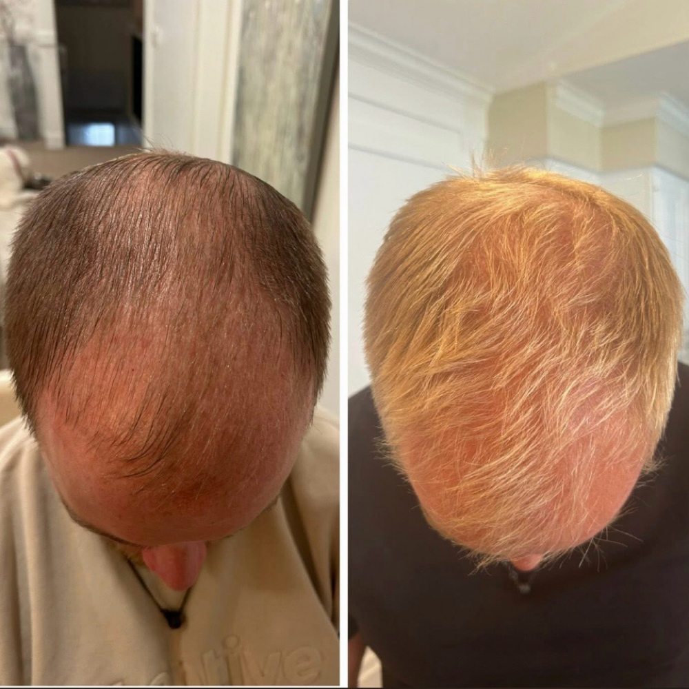 Micro Needling Hair Exosomes at Snatched Waxing & Aesthetics in Denver, CO