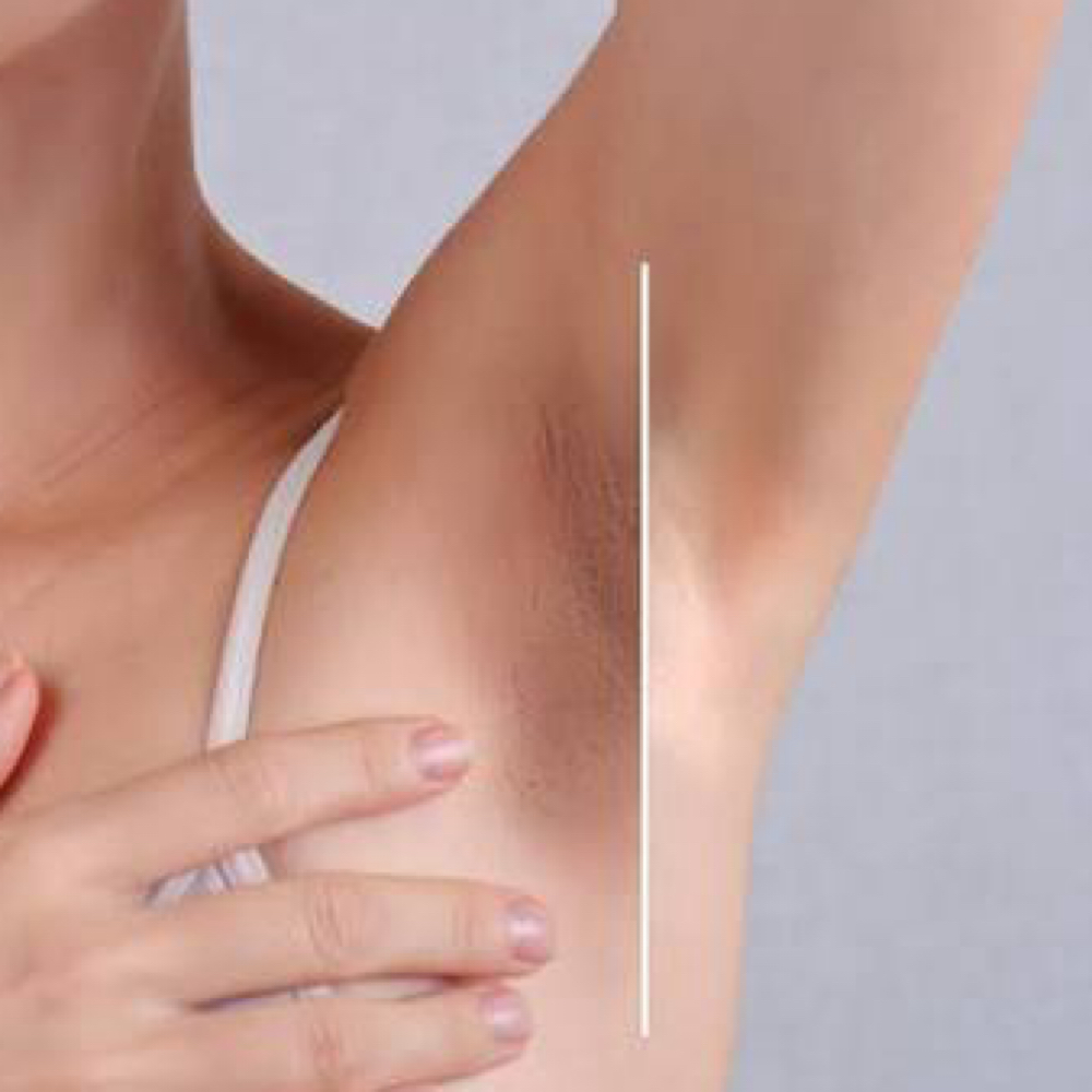 Underarm Brightening at Leidy Cornelio Spa in Aurora, CO