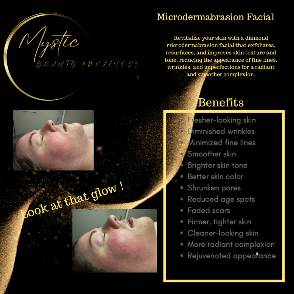 Microdermabrasion Facial