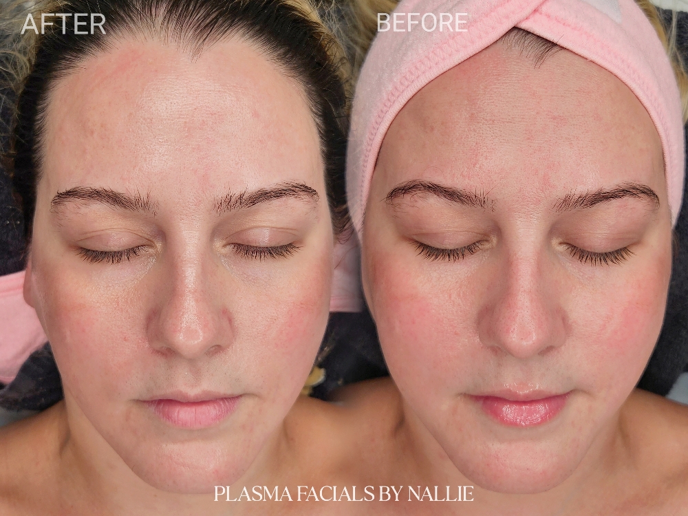 VIPLASMA FACIAL