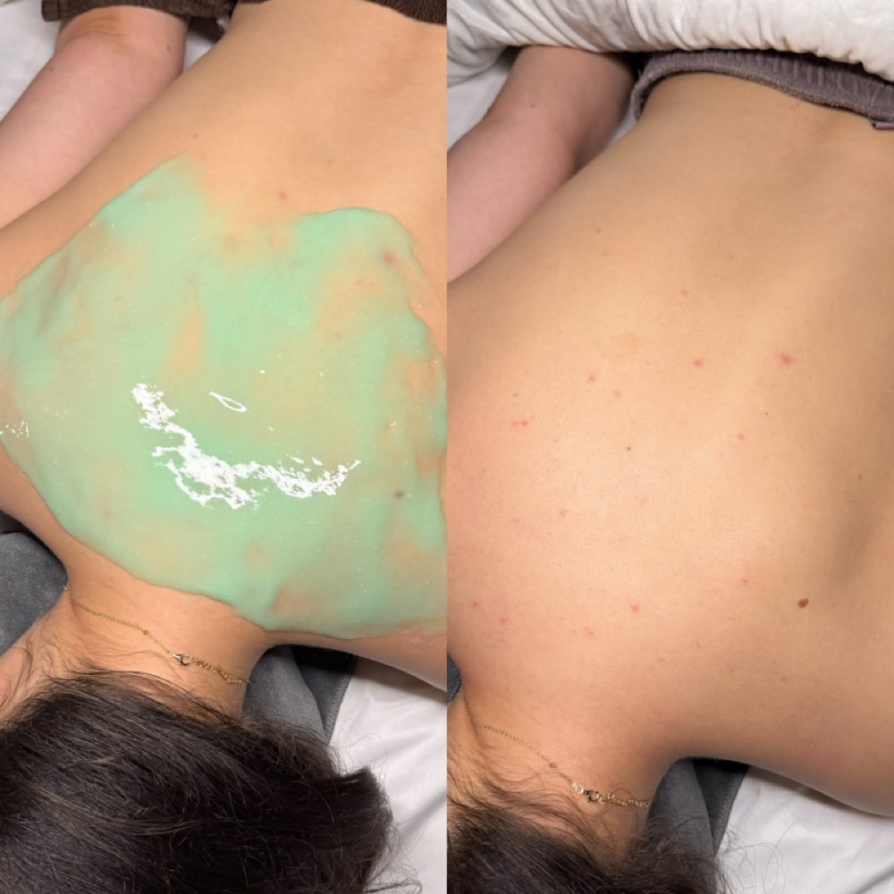 Signature Back Facial ☁️ at Studio Blanc in Richardson, TX