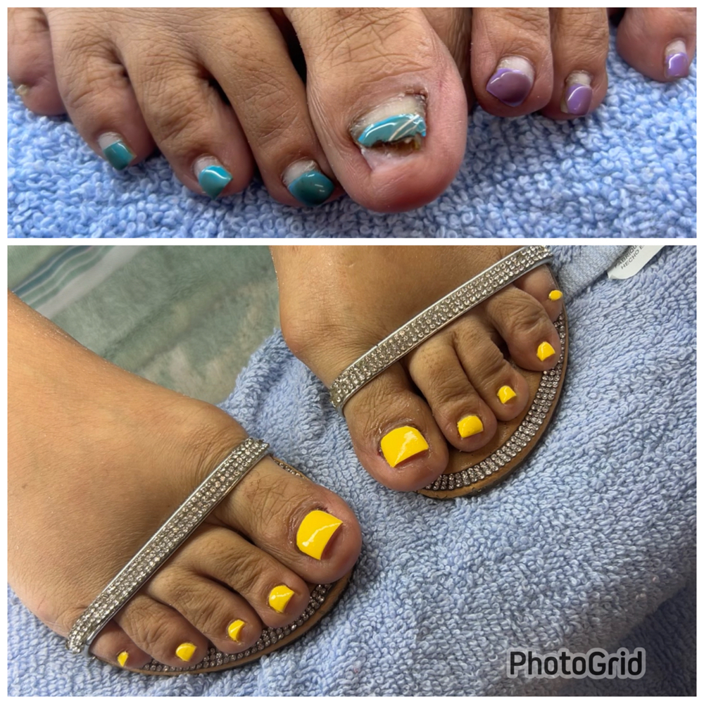 Toe Reconstruction at Lisa’s Nail House in Tampa, FL
