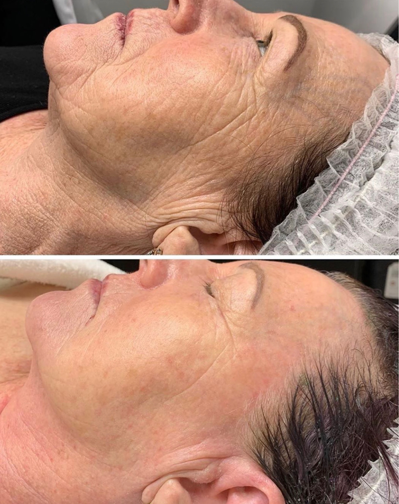 Age Treatment with DMK ENZYME Mask