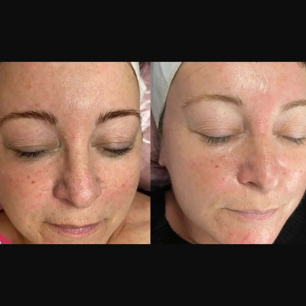 Microdermabrasion