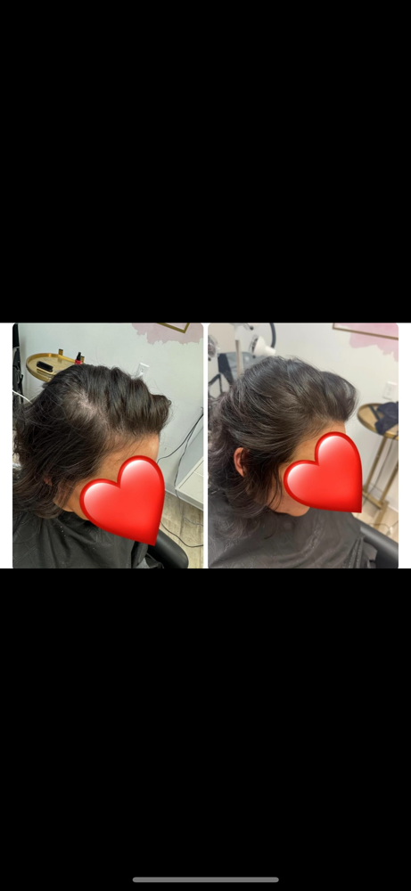 Woman Hair Growth Treatment Package