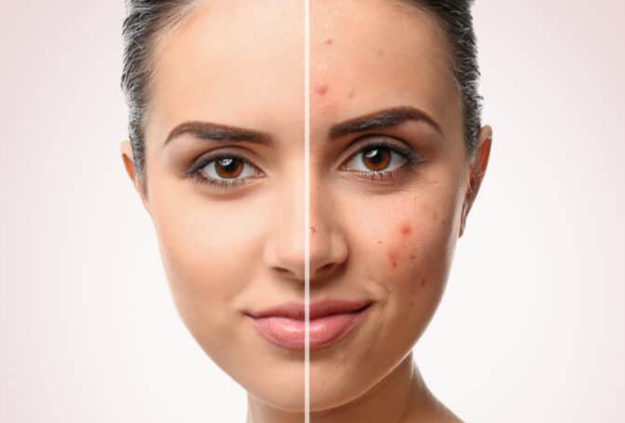 Acne Facial