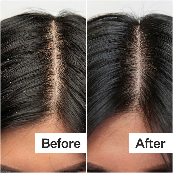 Scalp Exfoliation+Detox Treatment