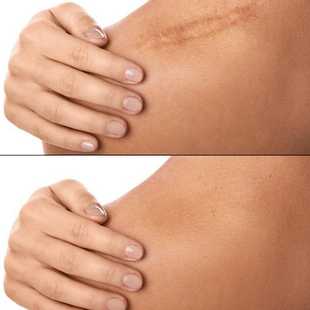 Laser scar removal