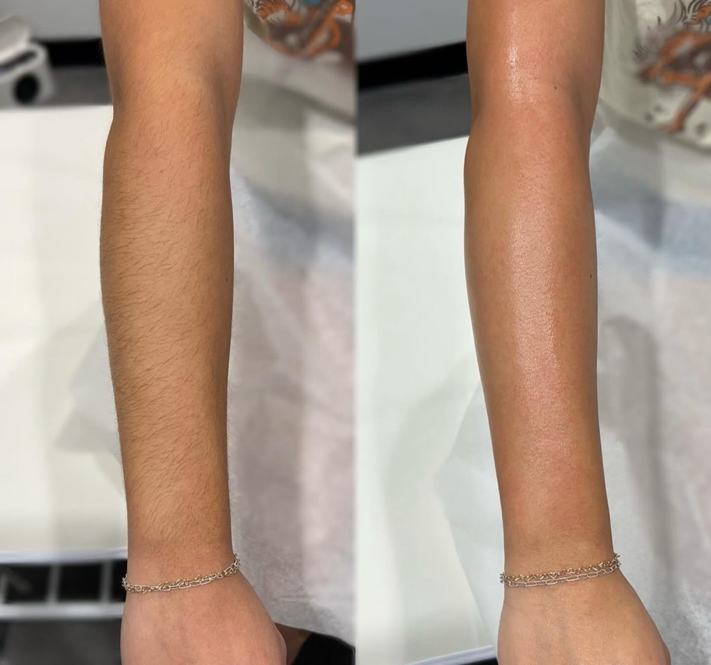 Half Arm Hair Removal at Yulee Mac Aesthetics in Tontitown, AR