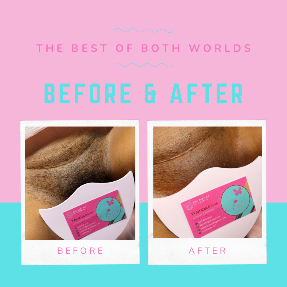 Full Brazilian Wax (4-6 Weeks)