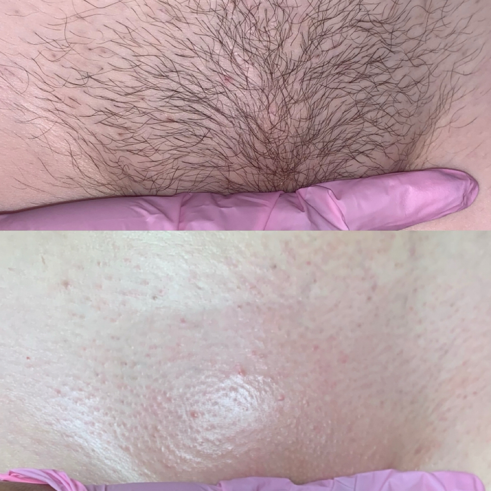 Bikini Full at Beauty Glow in Columbia, MO