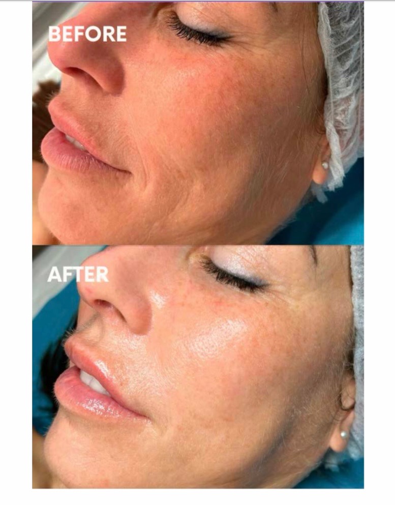 Salmon PDRN Skin Rejuvenation