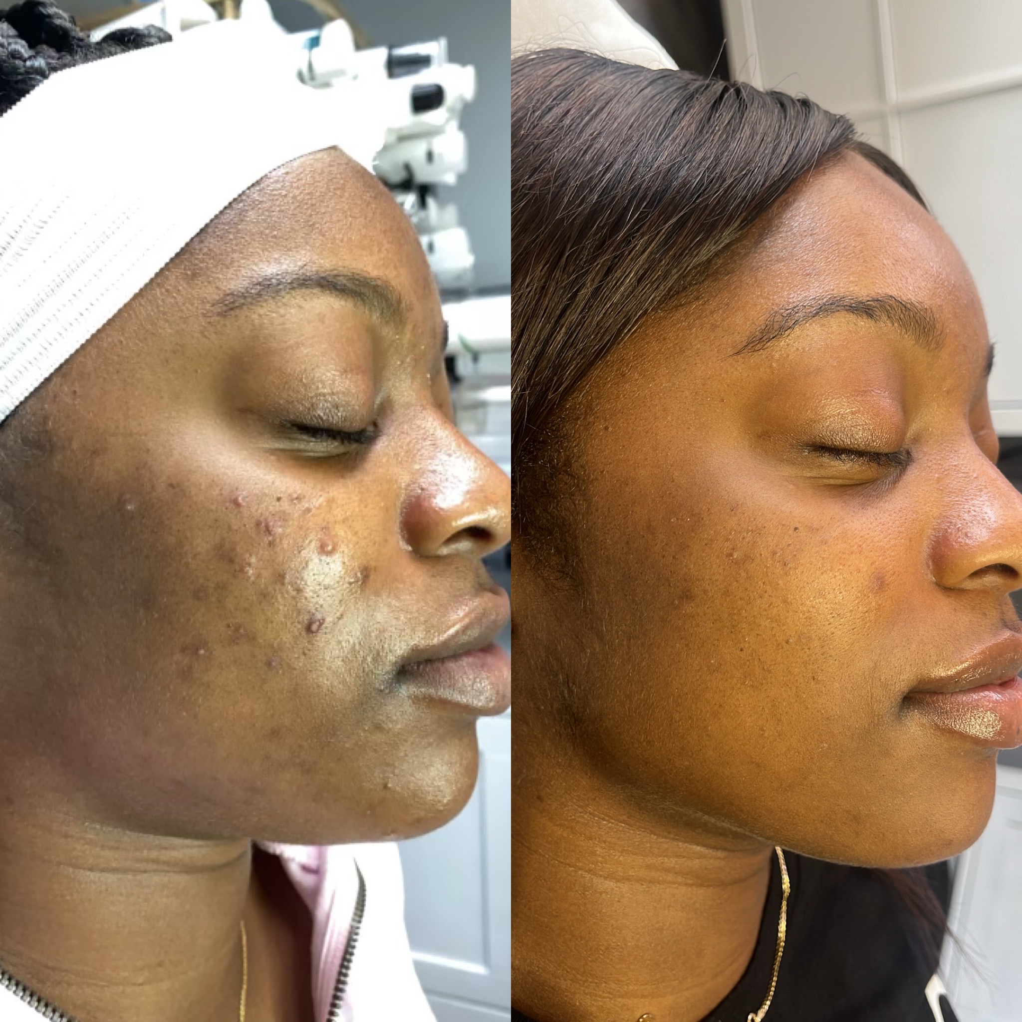 Advanced Customized Chemical Peel