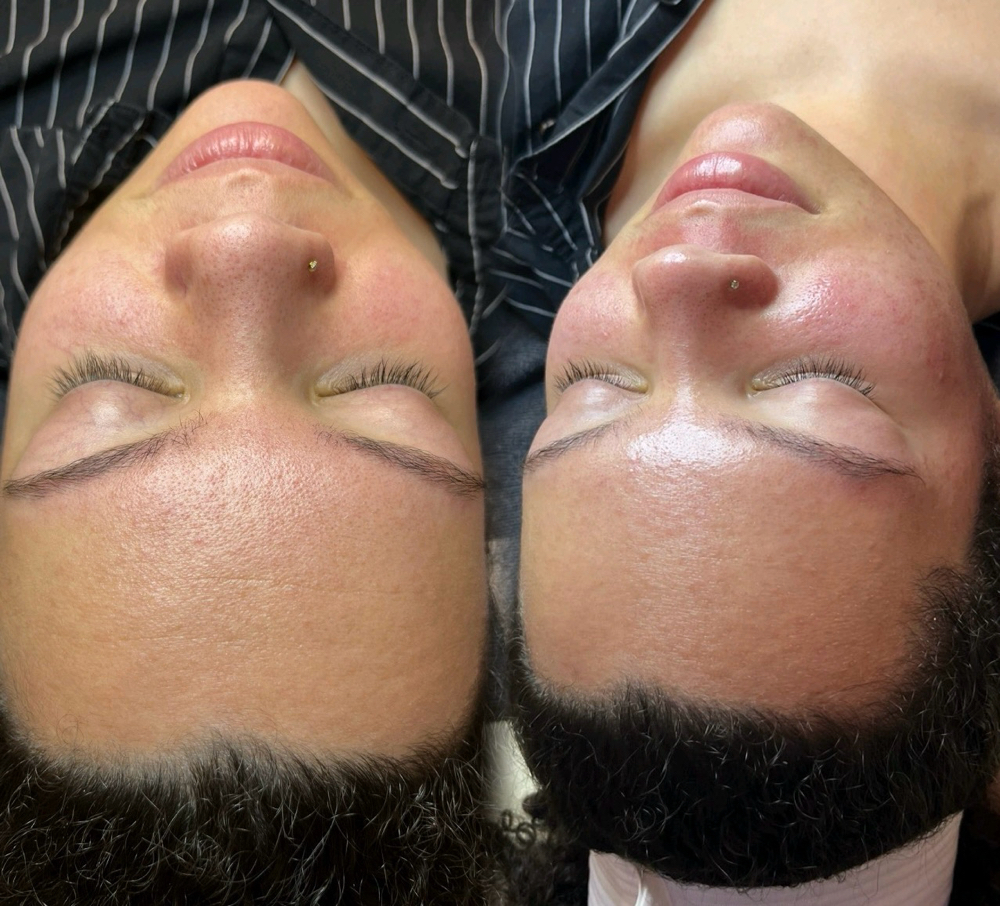 Chemical Peel