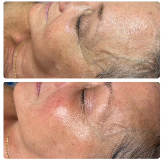 MicroNeedling Facial