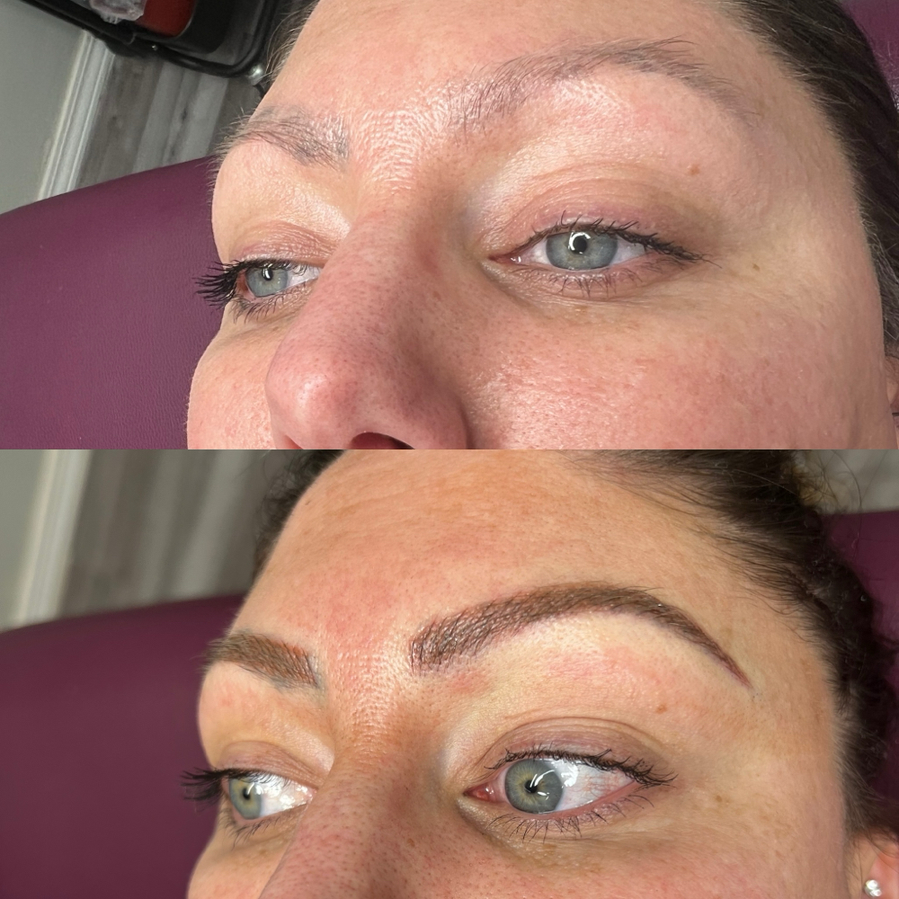 Brow Correction
