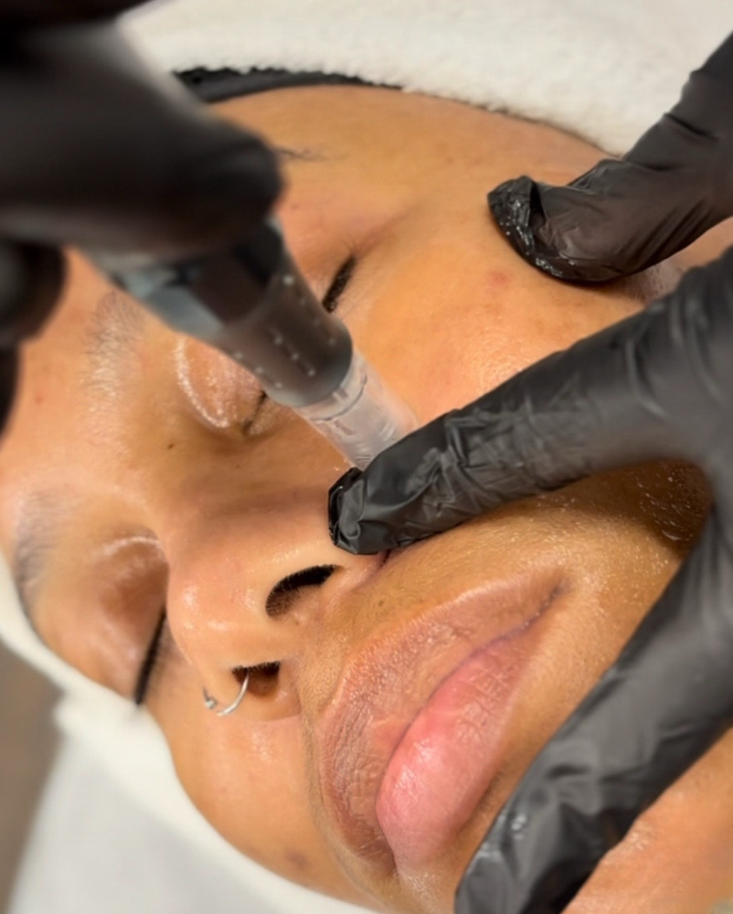 Pro NanoInfusion Treatment