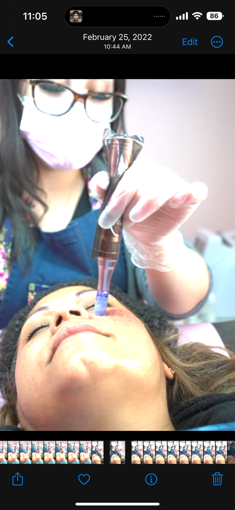 Microneedling