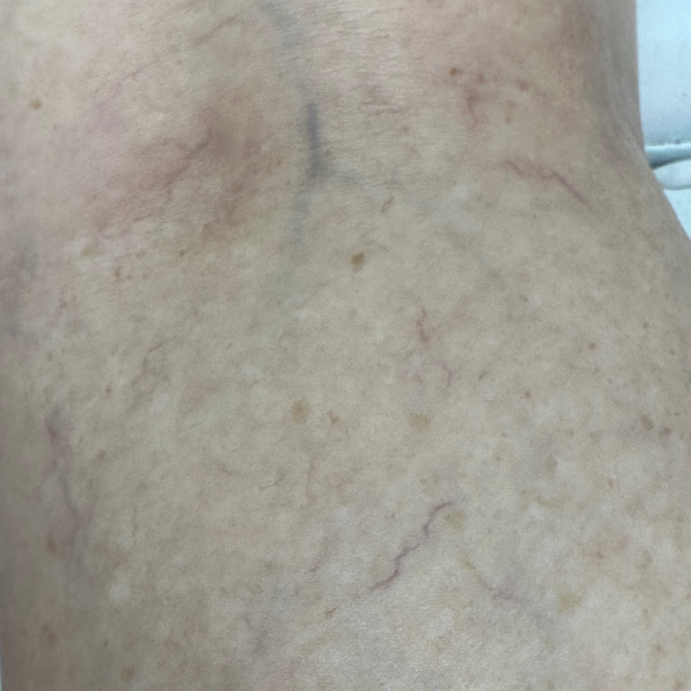 Vein Reduction at Erika’s Beauty Lab in Littleton, CO