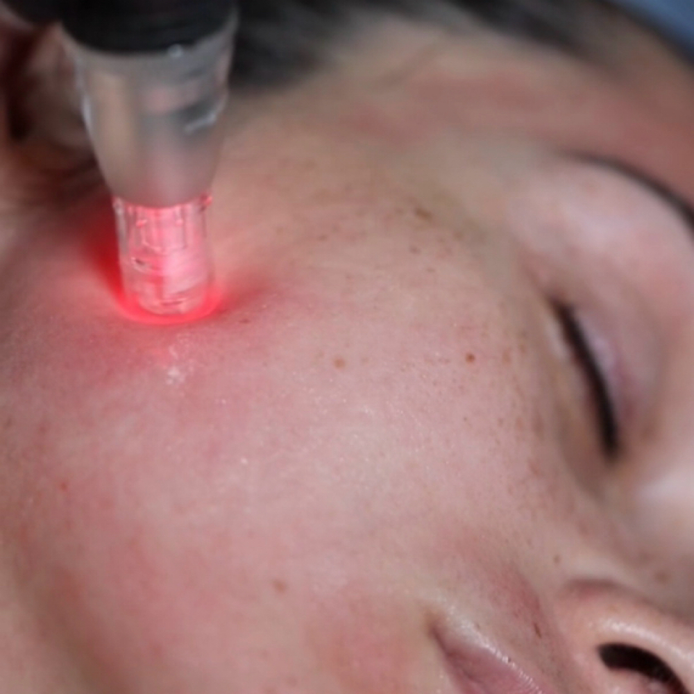 Microneedling Advanced PeelInfusion at Lalueurdejane in Miami, FL