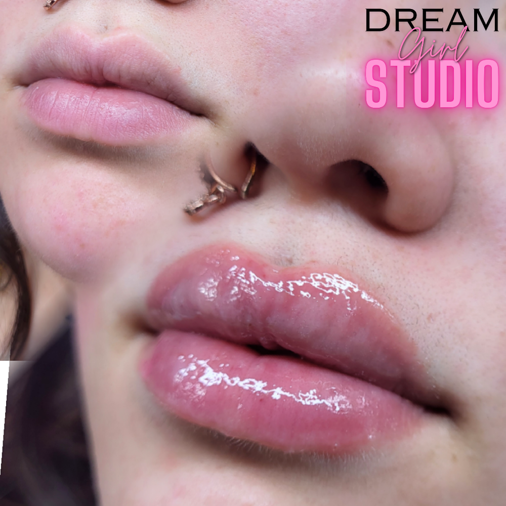 1ML Lip Filler