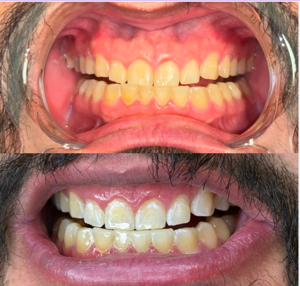 Teeth Whitening 45 Minutes