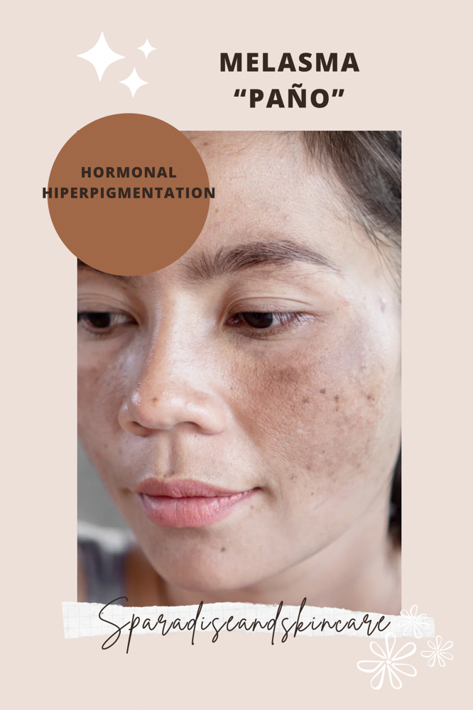 Melasma Treatment