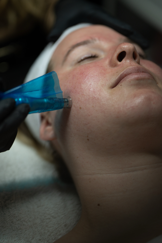 Nano-needling Treatment