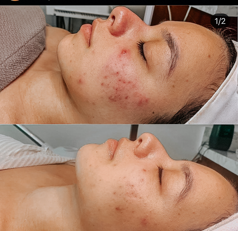 DermaFrost Peel