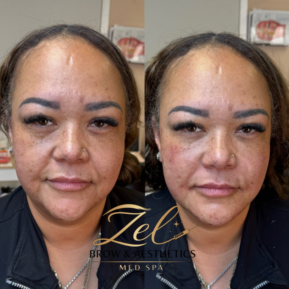 Facial Balancing at Zel Brow & Aesthetics Med Spa in Thornthon, CO