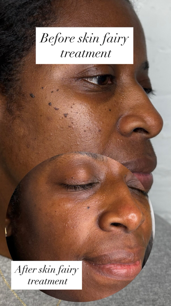 Skin Fairy Treatment