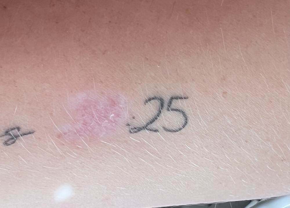 Non Laser Tattoo Removal