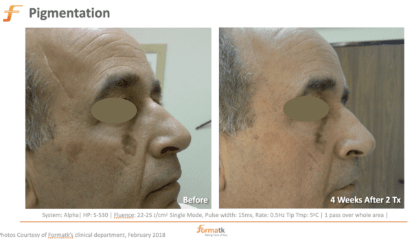 Pigmented Lesions - Face at Elegant Esthetics By Jozlyn in Lamar, CO