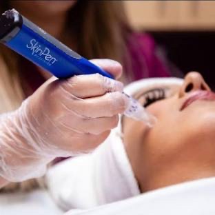 Microneedling SkinPen at Roots Aesthetic & Wellness LLC in McAllen, TX
