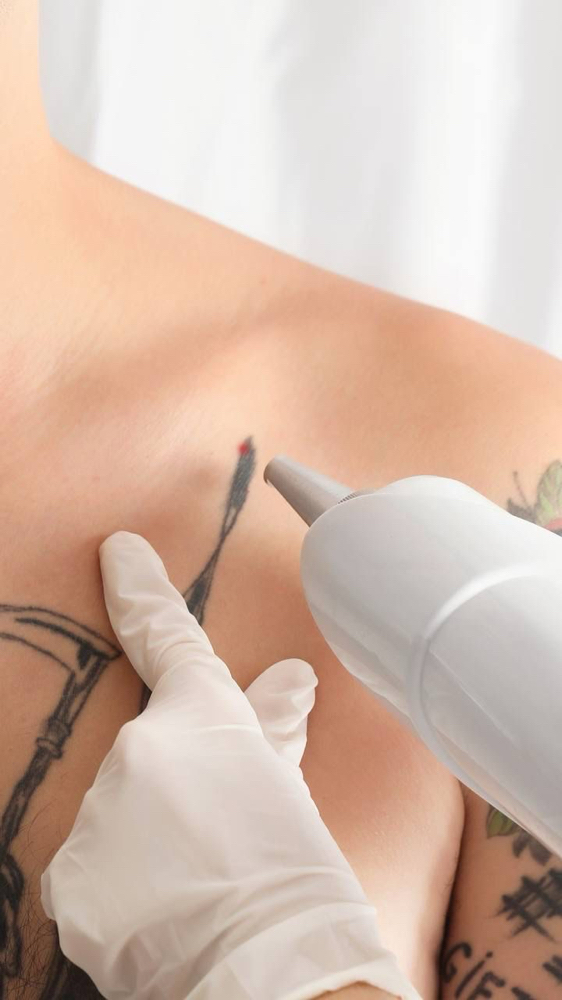 tattoo removal