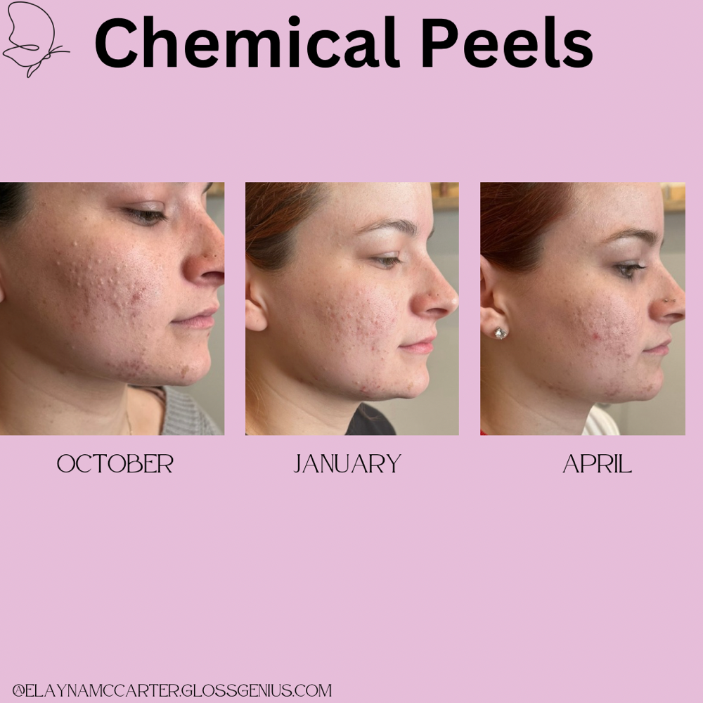 Membership (Chemical Peels)